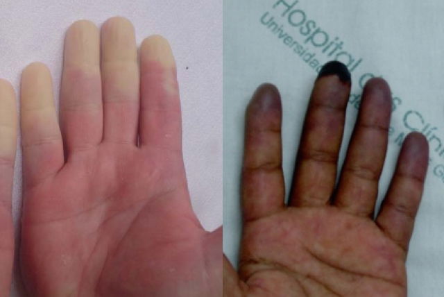 Síndrome De Raynaud Qué Es Síntomas Y Tratamiento Tua Saúde