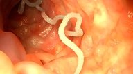 9 Symptoms of Intestinal Worms & Common Treatments