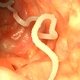 9 Symptoms of Intestinal Worms & Common Treatments