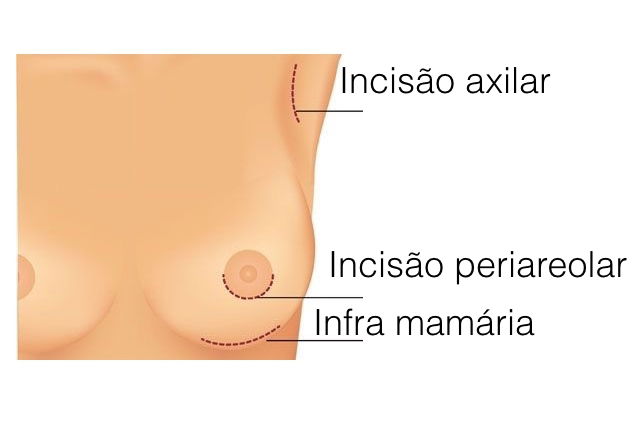 O que você precisa saber sobre a cirurgia para aumentar os seios