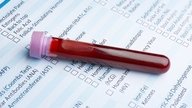 GGT Blood Test: What a High or Low Result Means