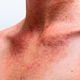 Urticaria nerviosa: qué es, síntomas y tratamiento
