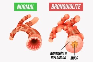 Imagem ilustrativa do artigo Bronquiolite: o que é, sintomas, causas e tratamento