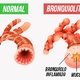 Bronquiolite: o que é, sintomas, causas e tratamento