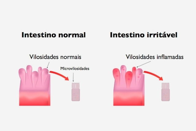 Síndrome do intestino irritável: o que é, sintomas e tratamento