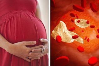 Imagem ilustrativa do artigo Colesterol alto na gravidez