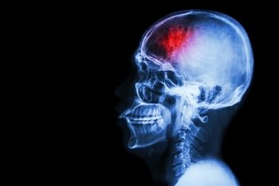 5 síntomas de aneurisma cerebral o aórtico 