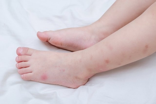 Dengue em crianças: sintomas, sinais de alerta e tratamento - Tua Saúde