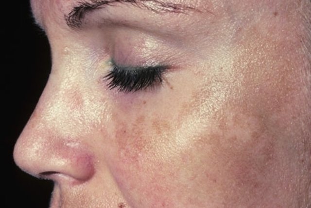 7 أنواع شائعة من البقع الداكنة على الجلد (وكيفية علاجها)
