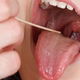 Throat Cancer: Symptoms, Causes & Treatment
