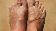 Manos y pies hinchados: 12 principales causas