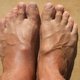 Manos y pies hinchados: 12 principales causas