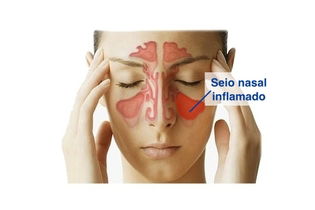 Seio nasal inflamado na sinusite