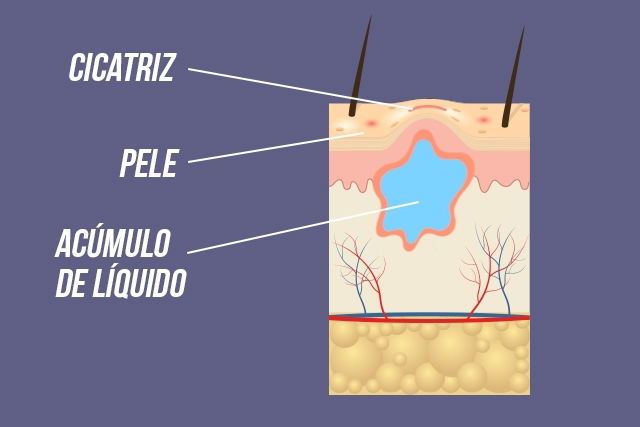 Seroma: o que é, sintomas e tratamento