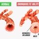 Bronquiolite obliterante: o que é, sintomas, causas e tratamento