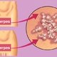 Transmissão do herpes genital: como se pega (e como evitar)