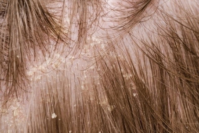 O que é dermatite e quais os diferentes tipos