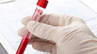 Proteína C Reactiva (PCR) alta: causas y valores normales
