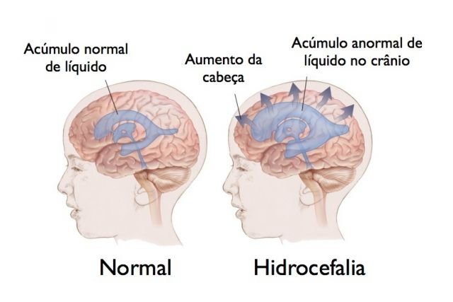 Hidrocefalia Tem Cura Tua Saúde 2581