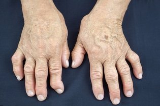 Imagen ilustrativa del artículo Artritis psoriásica: qué es, síntomas y tratamiento