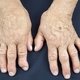 Artritis psoriásica: síntomas y tratamiento