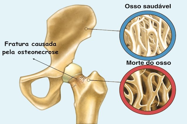 osteonecrose_20603 O que é Osteonecrose e como identificar