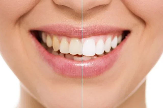 Antes e depois do clareamento dental