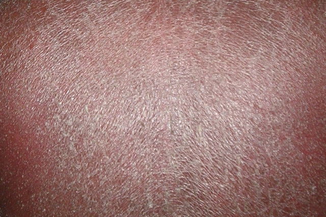 Dermatitis atópica