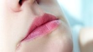 Angular Cheilitis: Symptoms, Causes & Treatment for Cracked Lip Corners