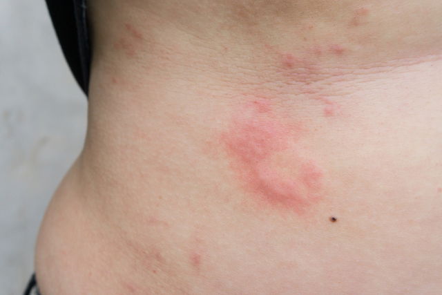 Tratamiento Para La Urticaria 4 Principales Opciones Tua Saúde