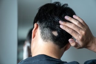 Imagem ilustrativa do artigo Alopecia areata: o que é, sintomas, causas e tratamento