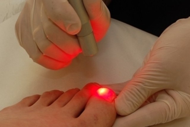 Como Tratar A Micose De Unha Remedios Laser E Opcoes Caseiras