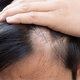 Alopecia: o que é, sintomas, causas e tratamento