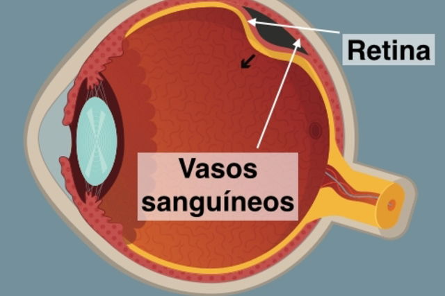 Retina Desgastada: Fuga do Planeta da Morte