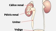 Ectasia Renal (Dilatación pielocalicial): Qué es, causas y tratamiento
