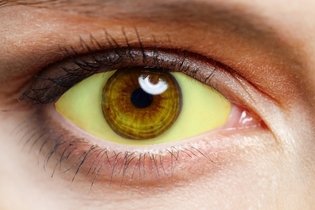 Olhos amarelos: 9 principais causas (e o que fazer)