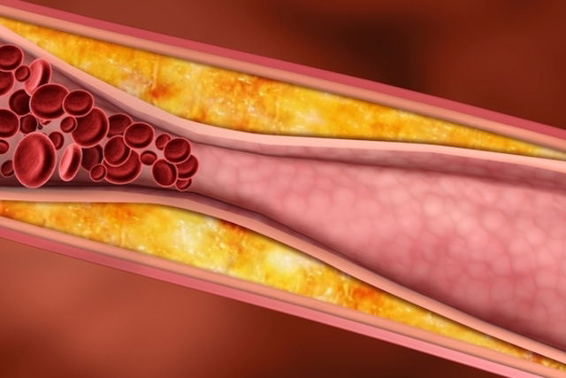 Valores De Colesterol Ldl Hdl Vldl E Total Tua Saúde 1093