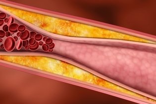 Image illustrative de l'article Différents types de cholestérol : LDL, HDL, VLDL et total