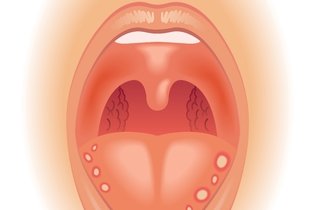 Illustrative image of the article What Causes Canker Sores? 7 Reasons They Keep Appearing