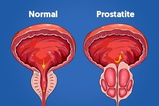 Prostatite: o que é, sintomas, causas e tratamento
