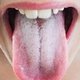 Burning Tongue: 5 Common Causes & How to Treat