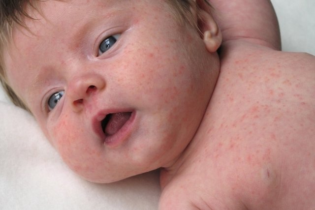 Sinais e sintomas de alergia alimentar no bebê