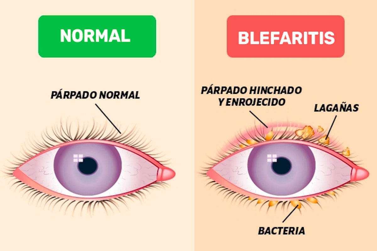 Blefaritis Síntomas Causas Y Tratamiento Con Remedios Caseros Tua Saúde 