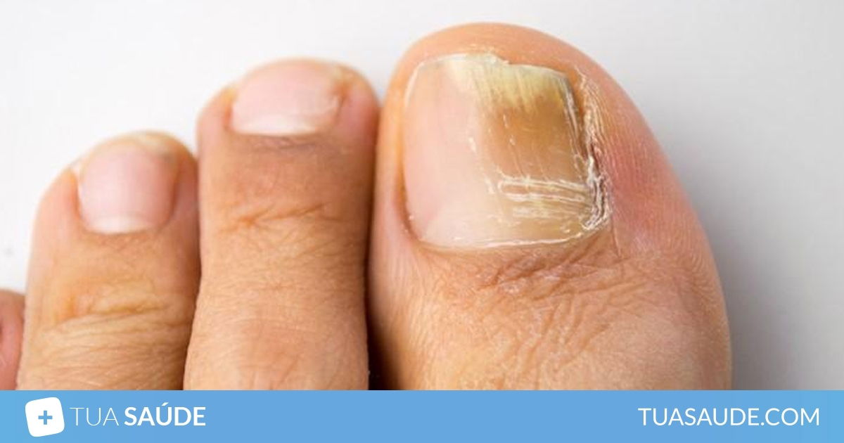 11 Alterações Nas Unhas Que Podem Indicar Problemas De Saúde E O Que