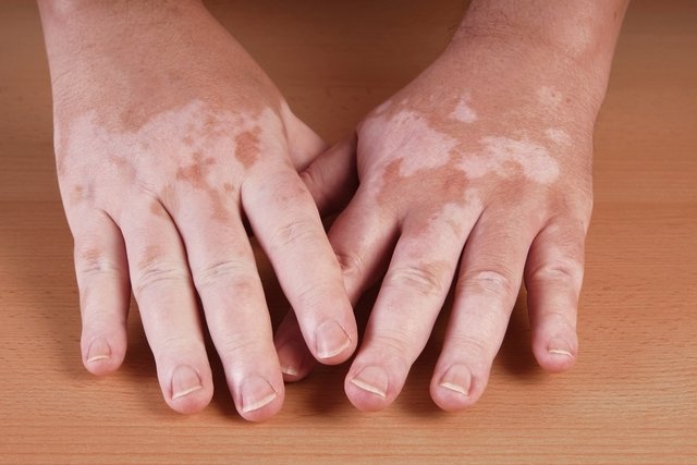 Was kann Vitiligo verursachen und wie man sie behandelt