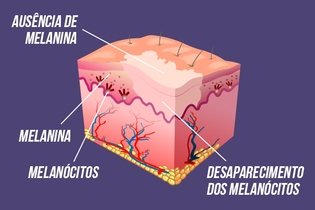 Imagen ilustrativa del artículo Vitiligo: qué es, causas y tratamiento