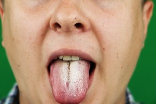 Imagen ilustrativa del artículo Principales enfermedades de la lengua y cómo tratarlas