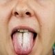 Principales enfermedades de la lengua y cómo tratarlas