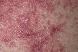 Creme psoriasis