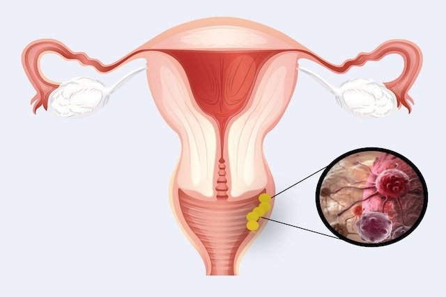 Cancerul de col uterin. Simptome